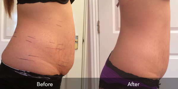 Face HIFU | Before & After | Flawless Body