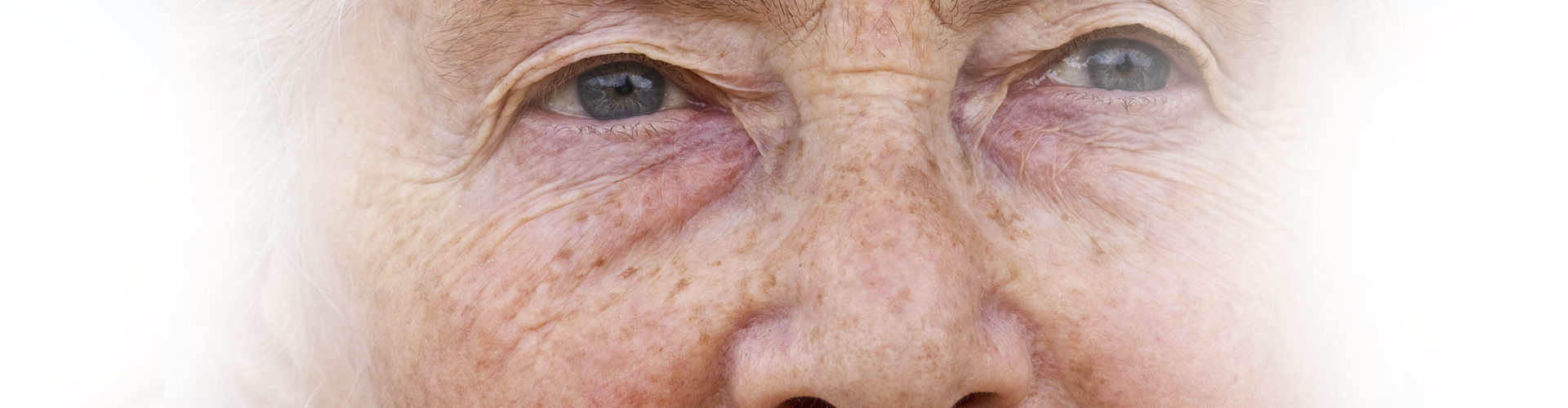 Age Spots | Flawless Body