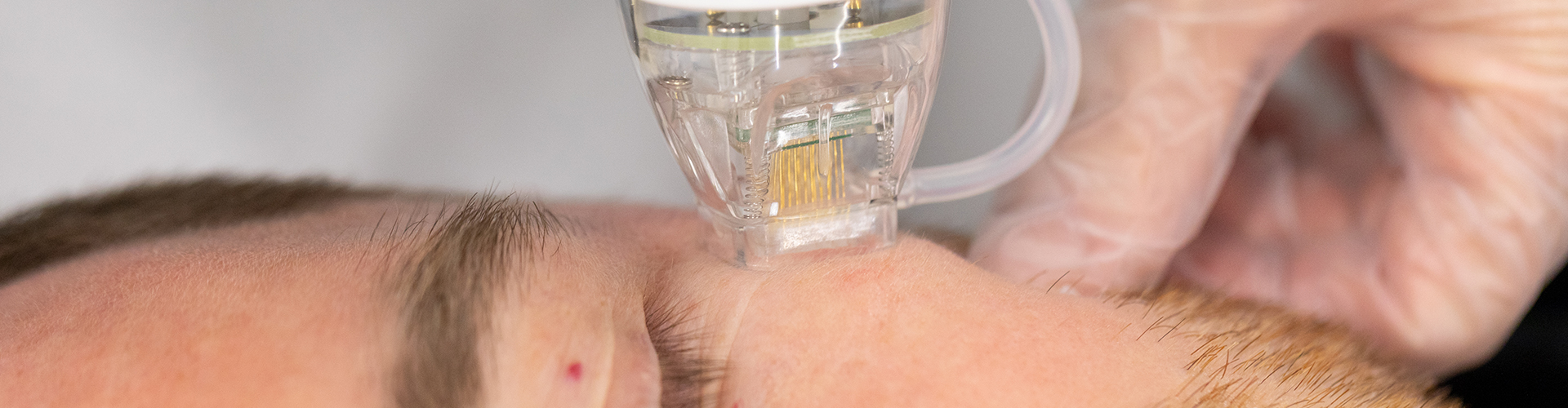 Microneedling | Flawless Body