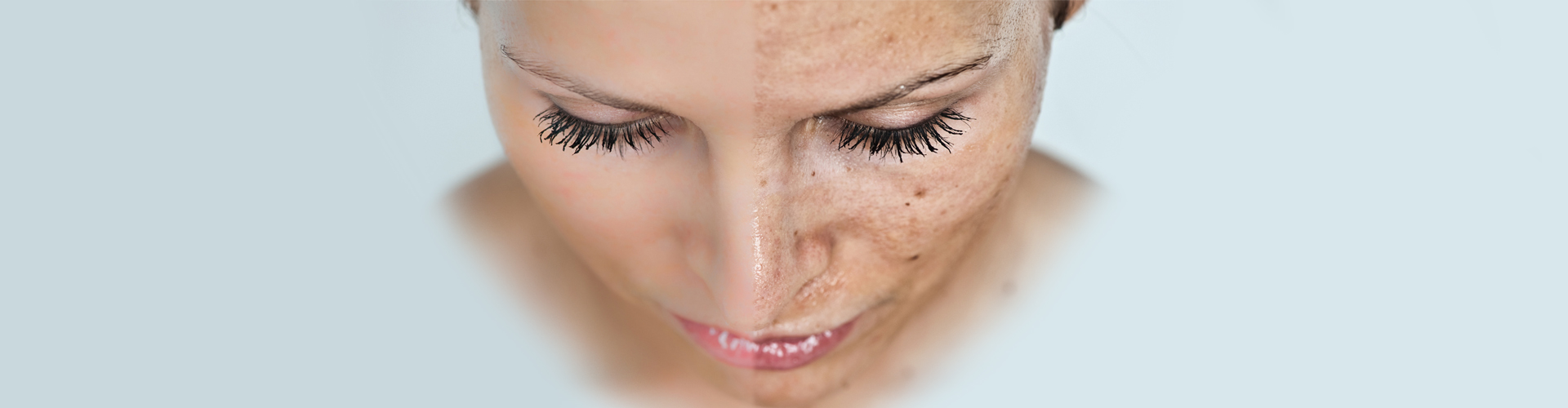 Acne Treatment | Flawless Body