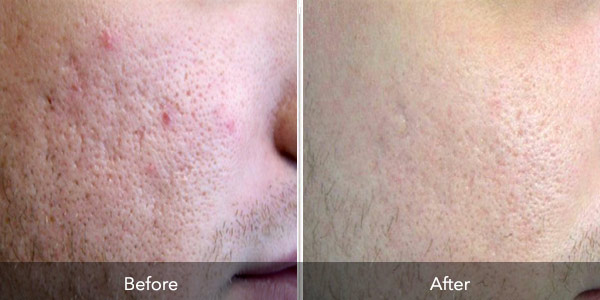 Tattoo Removal | Before & After | Flawless Body